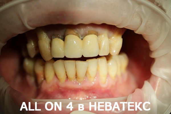 all on 4 фото до клиника неватекс all on 4 фото до